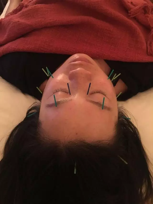 ai acupuncture