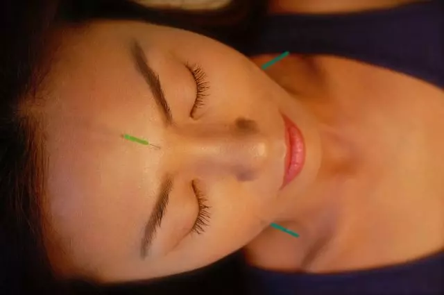 ai acupuncture