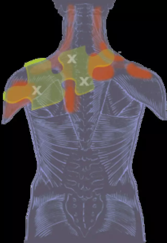 Myofascial Pain Solutions