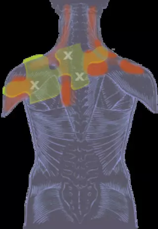 Myofascial Pain Solutions