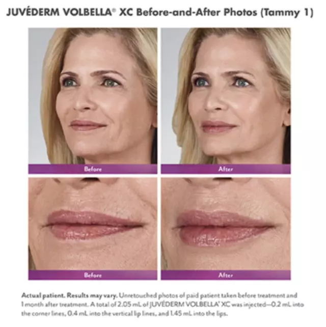 Irina Khidekel, MD - Cosmetic Injections