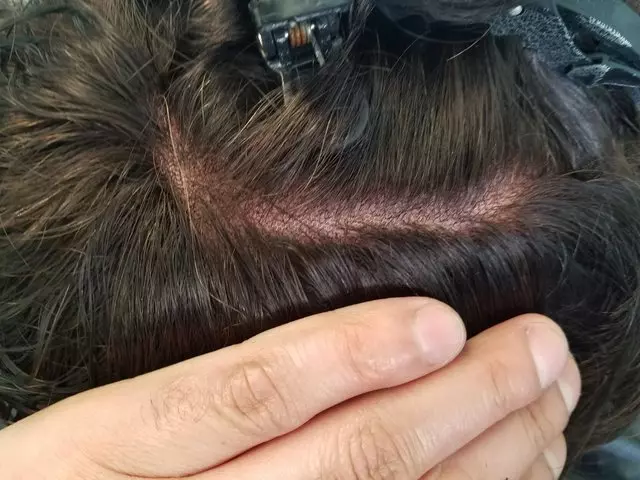 Peggy Tom Hair Replacement