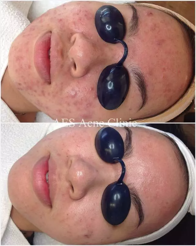 AES Acne Clinic