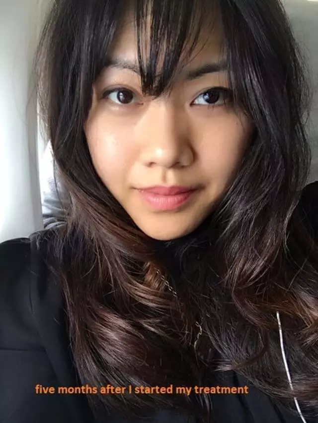 AES Acne Clinic