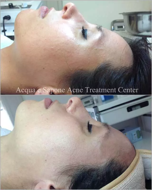 AES Acne Clinic