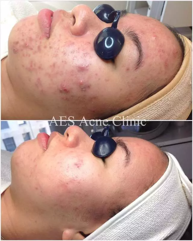 AES Acne Clinic