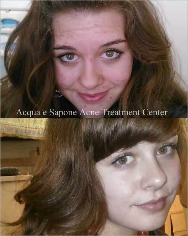 AES Acne Clinic