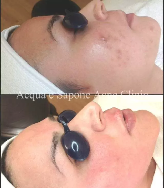 AES Acne Clinic