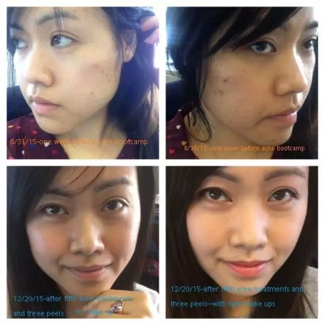 AES Acne Clinic
