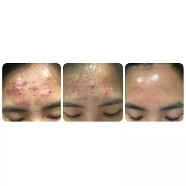 AES Acne Clinic